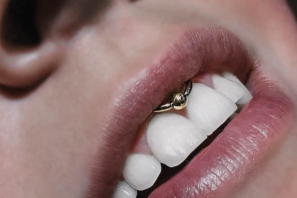 Smiley piercing