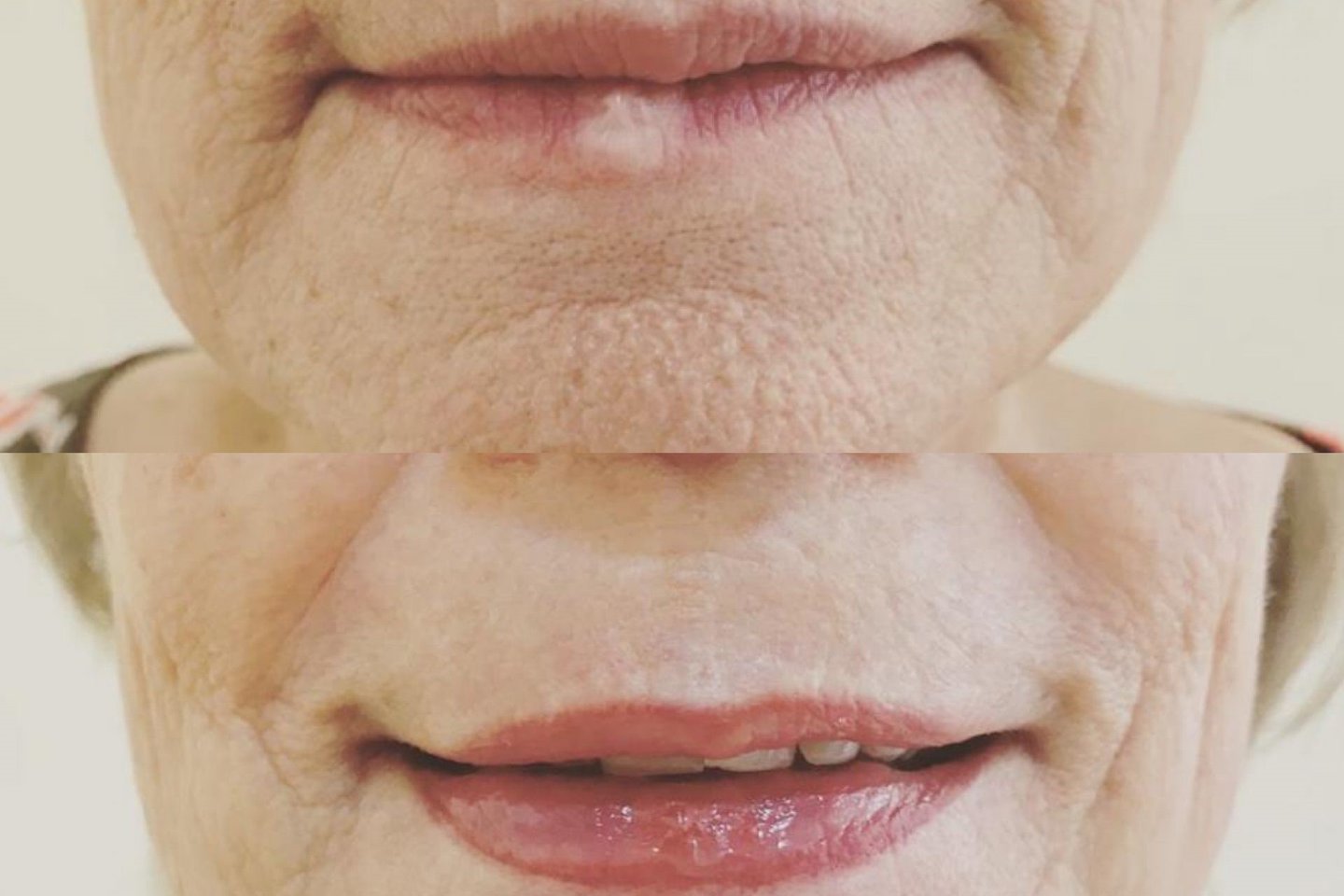 Permanentní make-up na jizvy