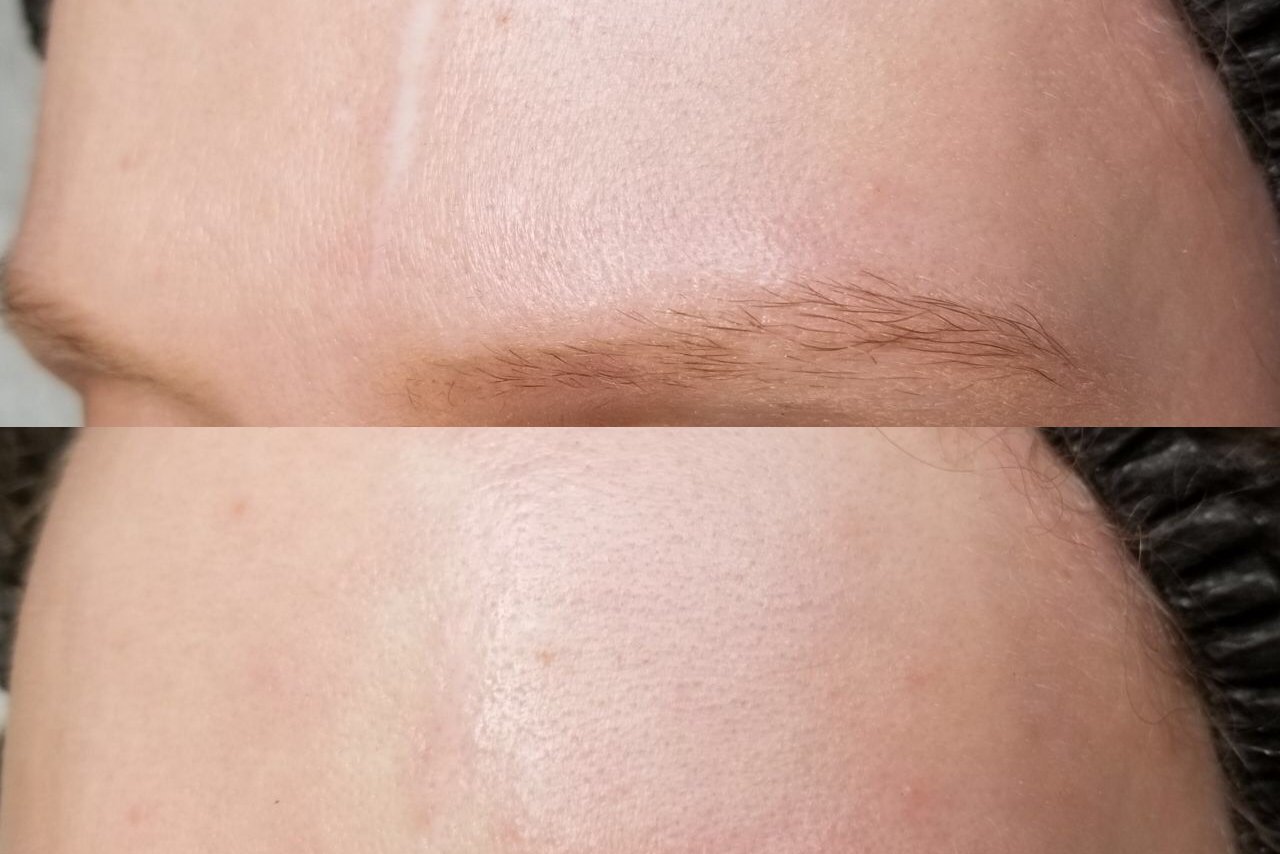 Permanentní make-up na jizvy