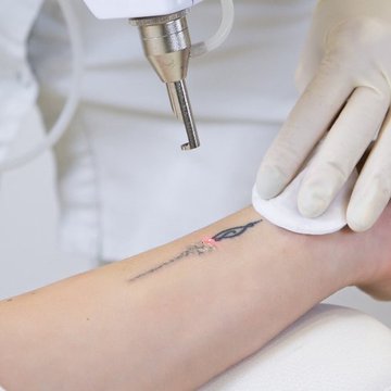 Rizika laserového odstranění
