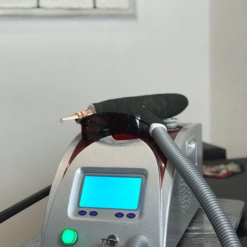 Laserové odstranění tetování v Brně