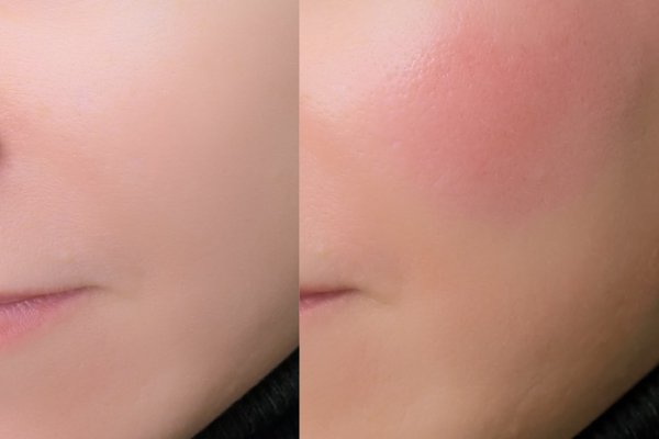 Permanentní make-up lícní kosti