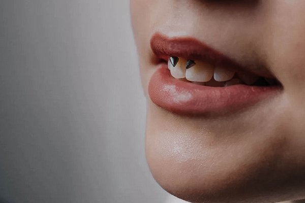 Smiley piercing