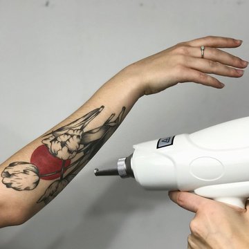 Rizika laserového odstranění