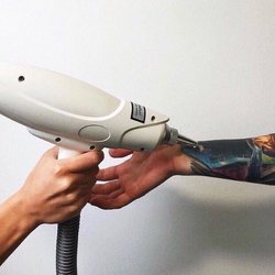 Rizika laserového odstranění